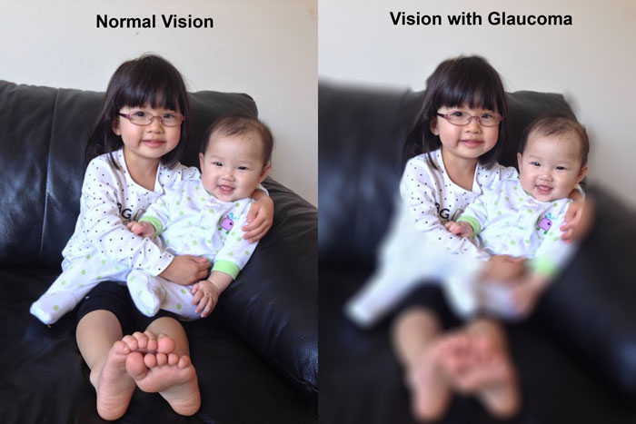 glaucoma patient risk