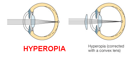 WW Hyperopia